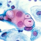 Chlamydia: symptomen, oorzaken, behandeling en prognose
