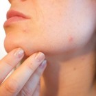 Acne en vette huid, behandeling met etherische olie