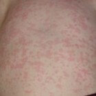 Parvovirus Parvovirus B19 infectie Soorten Ziekten Door Virus Parvovirus Parvovirus B19 infectie Soorten Ziekten Door Virus