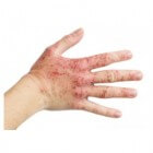 Handeczeem (eczeem aan de handen): symptomen en behandeling