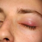 Chalazion (bultje onder ooglid): verwijderen en behandeling