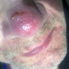 Rosacea symptomen: rode kleur wangen, neus & vlekken gezicht