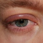 Blefaritis of ooglidontsteking: symptomen en behandeling