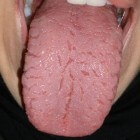 Jeukende tong: oorzaken en symptomen van jeuk aan de tong