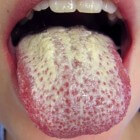 Candida-infectie van de mond (spruw): symptomen en oorzaak