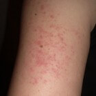 Ruwe plekken op de huid: oorzaken schrale plekken op de huid