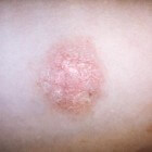 Pityriasis rosea: symptomen, oorzaak & behandeling huidgriep