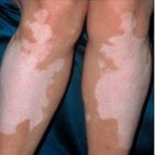 Vitiligo (pigmentverlies): symptomen, oorzaak en behandeling