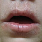 Liplik eczeem symptomen: ontstoken lippen & schilferende lip