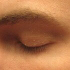 Gerstekorrels in gezicht: witte puntjes rond ogen of neus