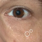 Syringomen: huidkleurige bultjes rond ogen en op wangen