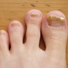 Vlek onder de nagel: oorzaken van bruine vlekken onder nagel