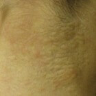 Pseudoxanthoma elasticum (PXE): gele bultjes op de huid