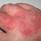 Atopisch eczeem: chronische ontstekingsziekte van de huid