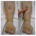 Gezwollen enkels en dikke voeten: oorzaken en behandeling