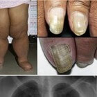 Gele nagel-syndroom: symptomen, oorzaak en behandeling