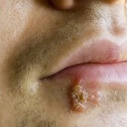 Koortslip: blaasjes op de lip - pijnlijk en branderig gevoel