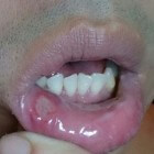 Blaasjes in de mond: oorzaken blaasjes of zweertjes in mond