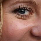 Rimpels onder de ogen: behandeling & zelfzorg van oogrimpels