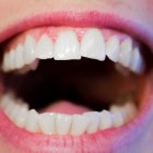 Hoe werkt de mondscanner van de tandarts?