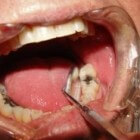Tips voor angst bij de tandarts