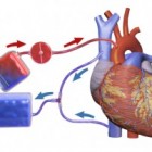Extracorporale circulatie: hart-longmachine