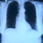 Röntgenstralen, effectief maar niet ongevaarlijk