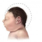 Microcefalie: Te klein hoofd door aandoeningen of infecties