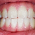 Rubberen tandenstokers: geen last meer van knakken of breken