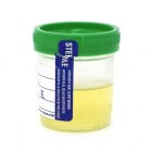 PH-waarde urine: pH meten & oorzaken te hoge/lage urine-pH