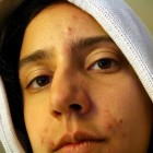 Fabels over acne en jeugdpuistjes