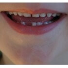Tanden wisselen bij kinderen; het verhaal van de tandenfee