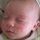 Babyacne (acne bij baby): symptomen, oorzaak en behandeling