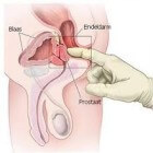 Prostaatkanker: Symptomen, Diagnose en Behandeling