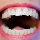 Droge mond (xerostomie): oorzaak en behandeling