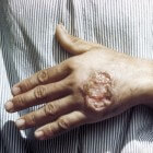 Leishmaniasis: symptomen, oorzaak, behandeling en prognose