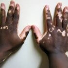 Vitiligo: oorzaak, diagnose en behandeling van de huid