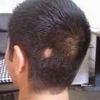 Alopecia areata, een auto-immuunziekte