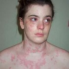 Koude-urticaria: allergische reactie op kou