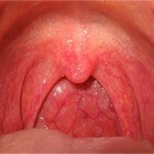 Ontstoken keelamandelen (tonsillitis) oorzaak en behandeling