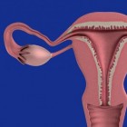 Risico op spijt na sterilisatie bij vrouwen
