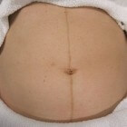 Zwangerschapsstreep (linea nigra): symptomen en voorkomen