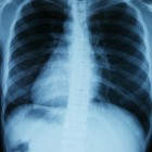 Tuberculose is een besmettelijke infectieziekte