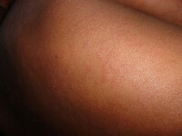 De ziekte kenmerkt zich door vlekjes op de huid. / Bron: Geralt, Pixabay
