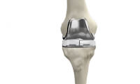 Knieprothese met lichaamsvreemd materiaal / Bron: ConforMIS, Wikimedia Commons (CC BY-SA-3.0)