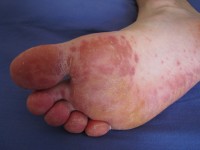 Inleg Ongeschikt onderdelen Hand-, voet- en mondziekte bij volwassenen | Mens en Gezondheid: Ziekten