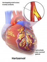 Ontstaan hartinfarct door een embolie ten gevolgen van atherosclerose / Bron: Blausen Medical Communications, Inc., Wikimedia Commons (CC BY-3.0)