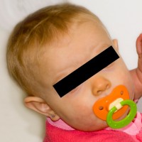 Kind met carotenemie, met name van de neus / Bron: Foiltape, Wikimedia Commons (CC BY-3.0)