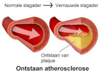 Atherosclerose in beeld gebracht / Bron: Blausen.com, Wikimedia Commons (CC BY-3.0)