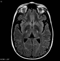 MRI onderzoek hersenen / Bron: Frank Gaillard, Wikimedia Commons (CC BY-SA-3.0)